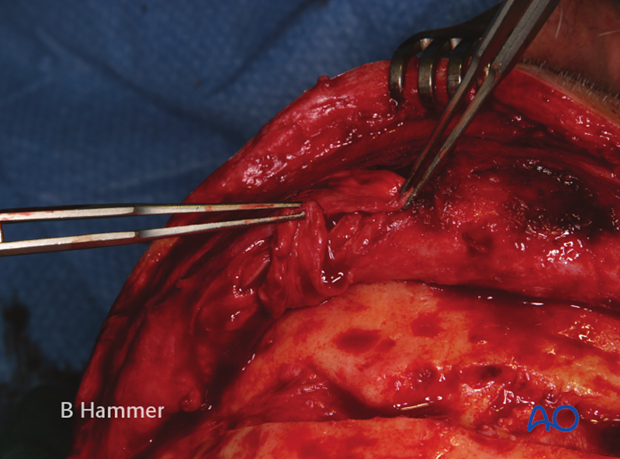 Case example: Infection of a PMMA graft causing recurrent fistulae