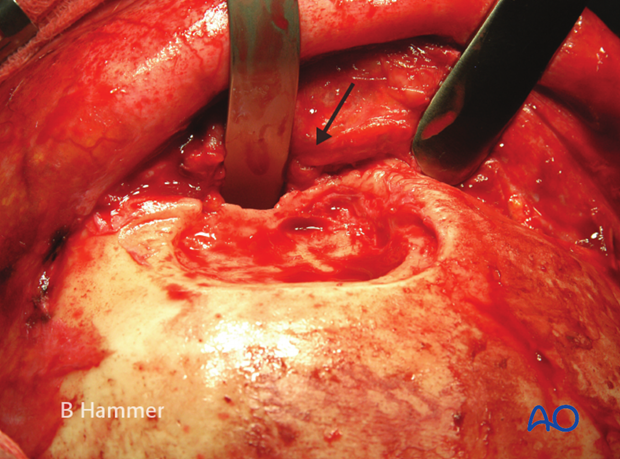 Case example: Infection of allogenic graft, causing swelling and chronic headache