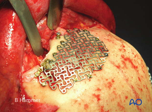 Case example: Infection of allogenic graft, causing swelling and chronic headache