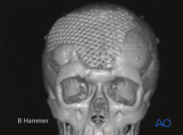 Case example: Exposure of a titanium mesh through the skin