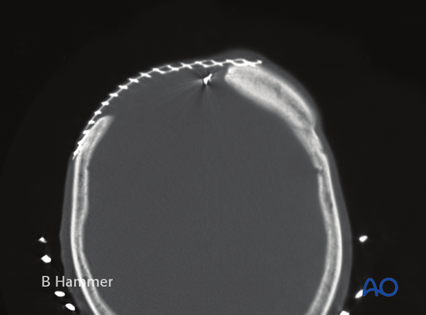 Case example: Exposure of a titanium mesh through the skin