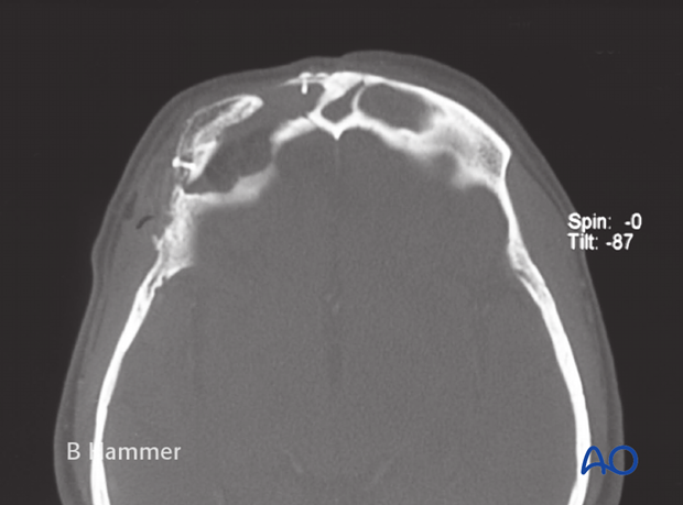 Case example: Osteomyelitis of the supraorbital rim with fistulization