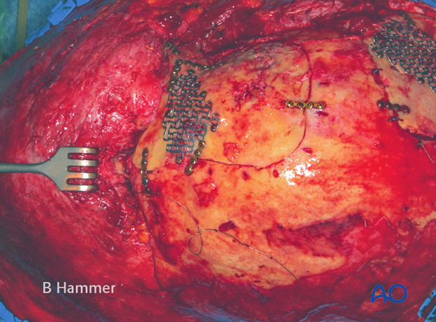 Case example: Osteomyelitis of the supraorbital rim with fistulization