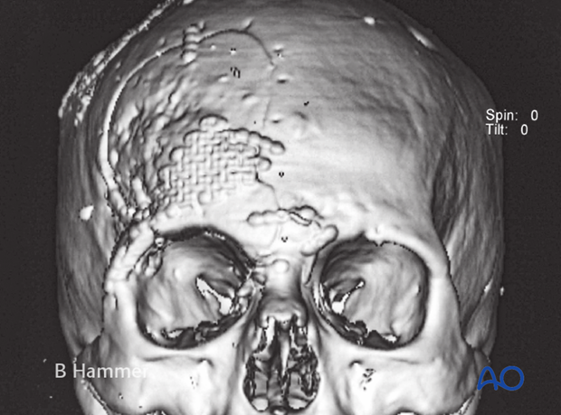 Case example: Osteomyelitis of the supraorbital rim with fistulization