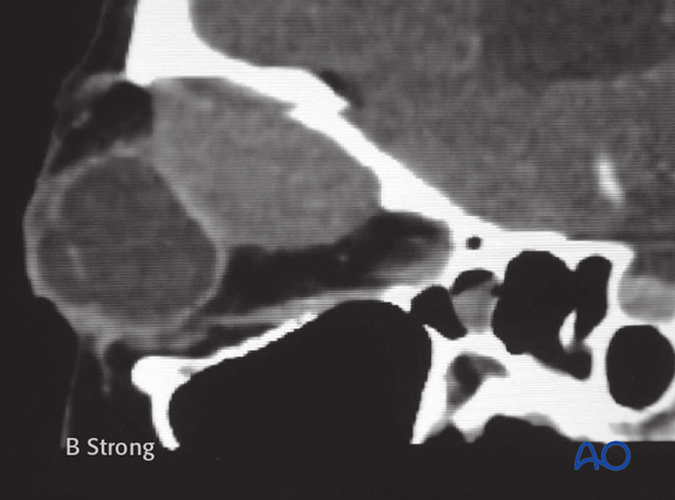 Operative techniques: Transnasal endoscopic approach