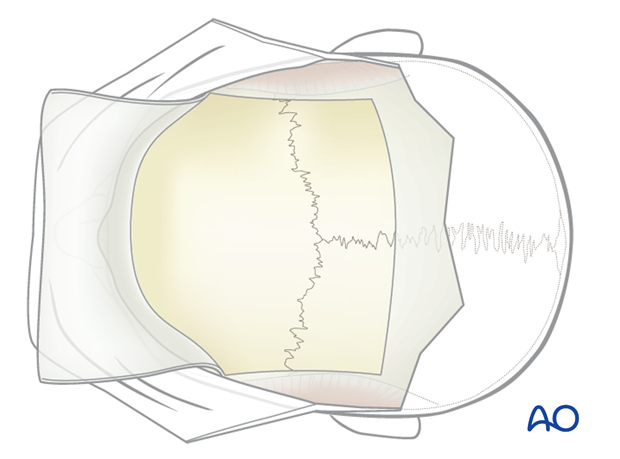 Harvesting of calvarial bone graft