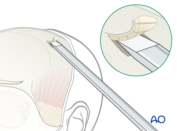 Harvesting of calvarial bone graft