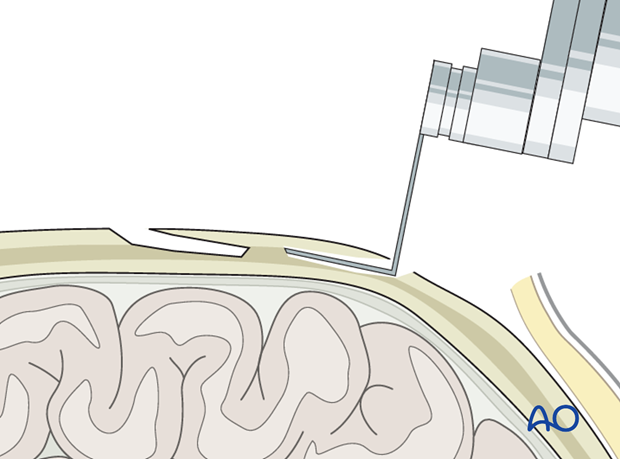 Harvesting of calvarial bone graft