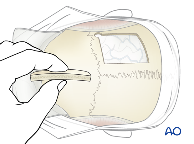 Harvesting of calvarial bone graft