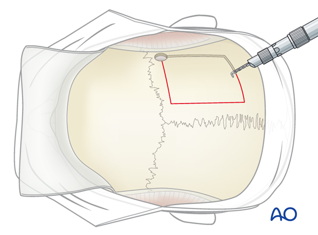 Harvesting of calvarial bone graft