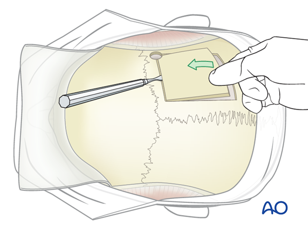 Harvesting of calvarial bone graft