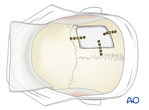 Harvesting of calvarial bone graft