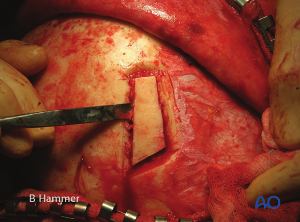 Harvesting of calvarial bone graft