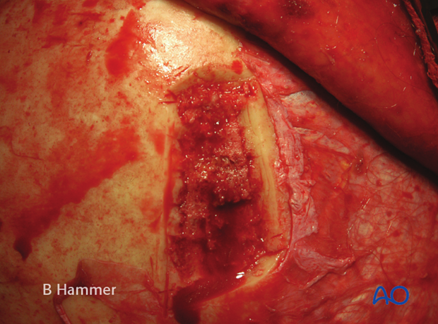 Harvesting of calvarial bone graft