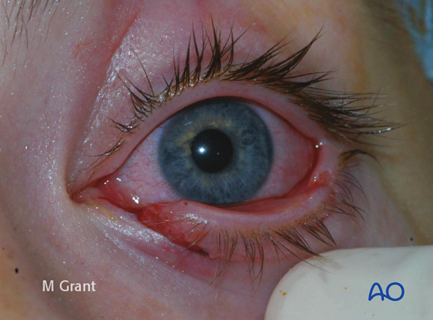 Repair of periorbital soft-tissue injuries and lacrimal system in NOE injuries