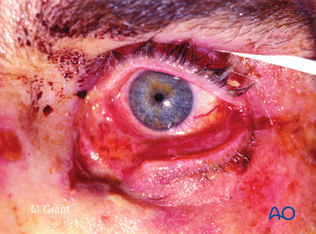 Repair of periorbital soft-tissue injuries and lacrimal system in NOE injuries