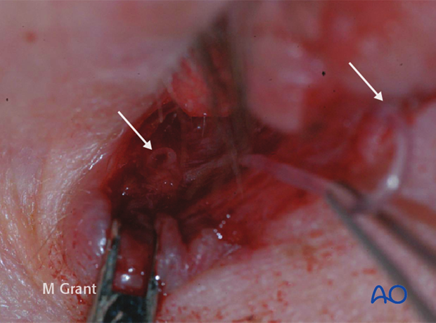 Repair of periorbital soft-tissue injuries and lacrimal system in NOE injuries