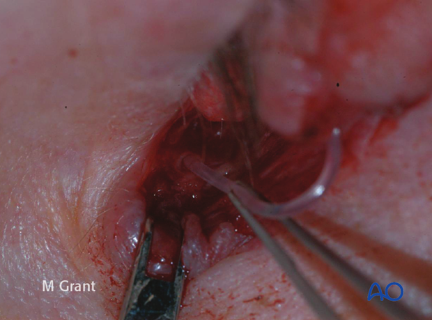 Repair of periorbital soft-tissue injuries and lacrimal system in NOE injuries