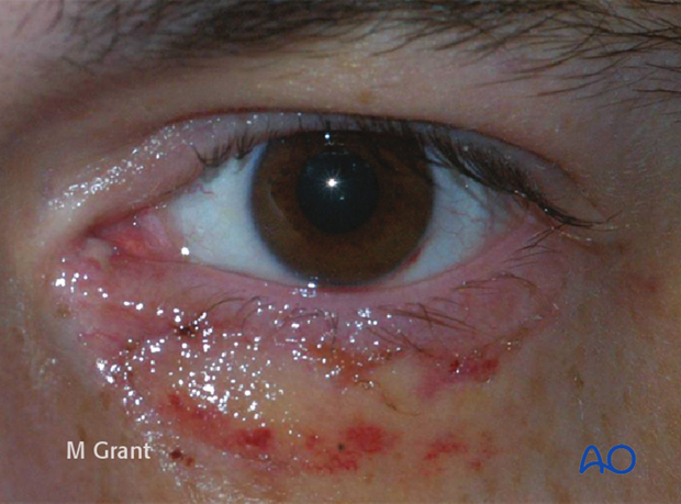 Repair of periorbital soft-tissue injuries and lacrimal system in NOE injuries