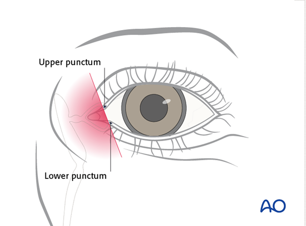 Repair of periorbital soft-tissue injuries and lacrimal system in NOE injuries