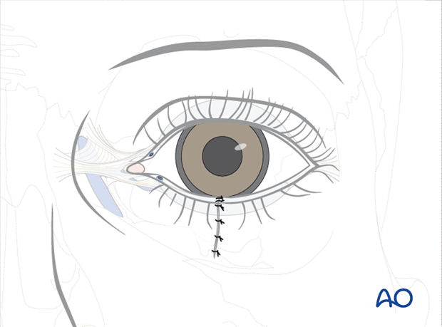 Repair of periorbital soft-tissue injuries and lacrimal system in NOE injuries