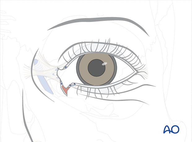 Repair of periorbital soft-tissue injuries and lacrimal system in NOE injuries