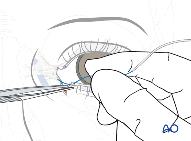 Repair of periorbital soft-tissue injuries and lacrimal system in NOE injuries