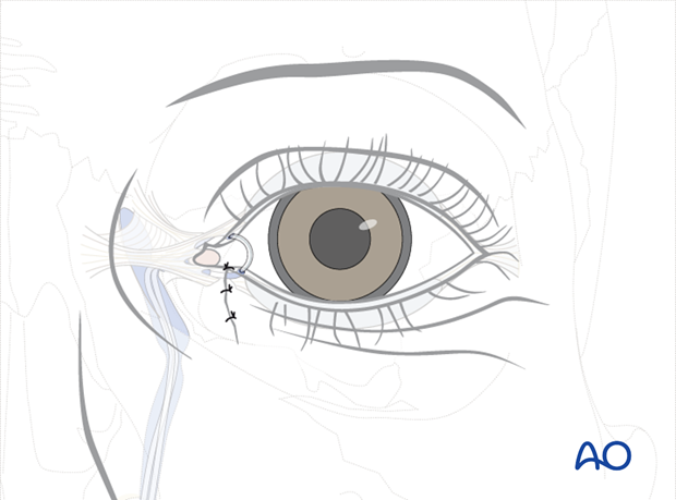 Repair of periorbital soft-tissue injuries and lacrimal system in NOE injuries