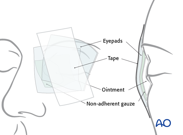 Repair of periorbital soft-tissue injuries and lacrimal system in NOE injuries