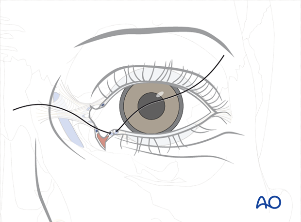 Repair of periorbital soft-tissue injuries and lacrimal system in NOE injuries