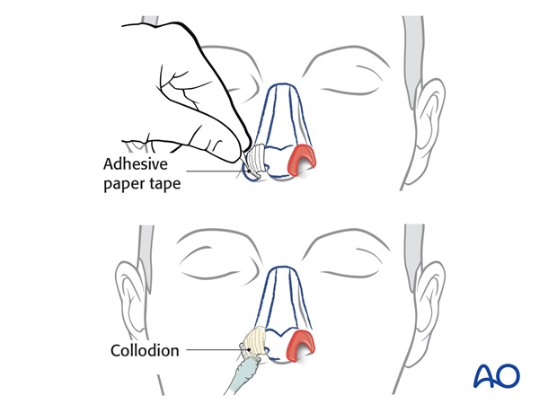 Nose Reconstruction by Dr. Frederick J Menick