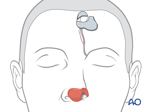 Nose Reconstruction by Dr. Frederick J Menick