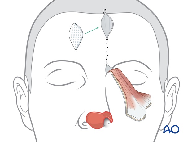 Nose Reconstruction by Dr. Frederick J Menick