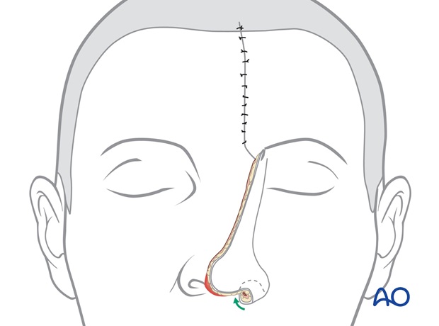 Nose Reconstruction by Dr. Frederick J Menick