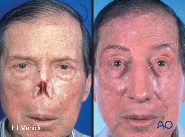 Nose Reconstruction by Dr. Frederick J Menick