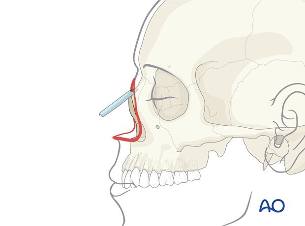 Nose Reconstruction by Dr. Frederick J Menick