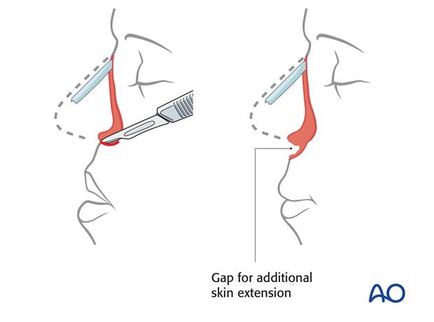 Nose Reconstruction by Dr. Frederick J Menick