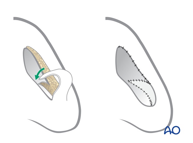 revision surgery