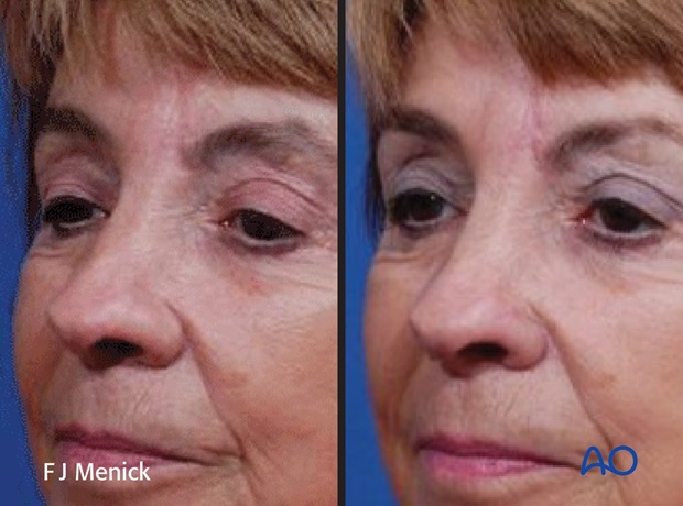 Nose Reconstruction by Dr. Frederick J Menick