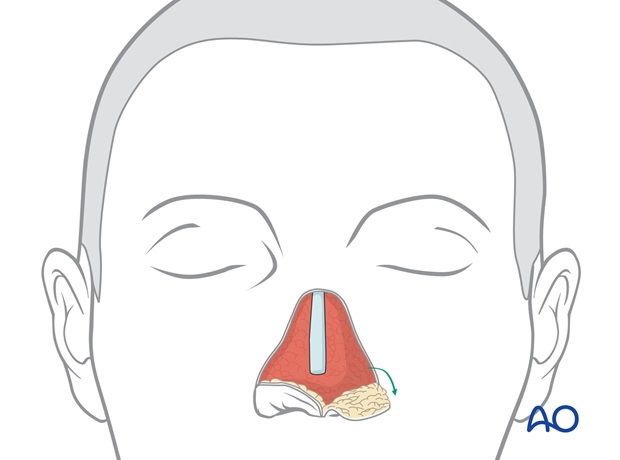 Nose Reconstruction by Dr. Frederick J Menick