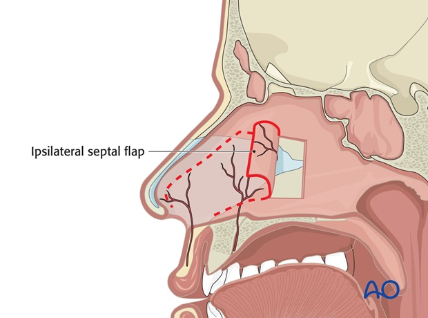 Nose Reconstruction by Dr. Frederick J Menick