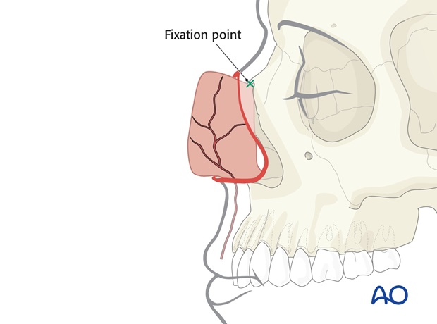 Nose Reconstruction by Dr. Frederick J Menick