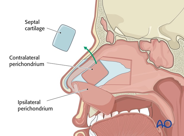 Nose Reconstruction by Dr. Frederick J Menick