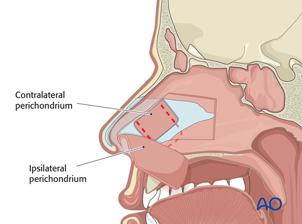 Nose Reconstruction by Dr. Frederick J Menick