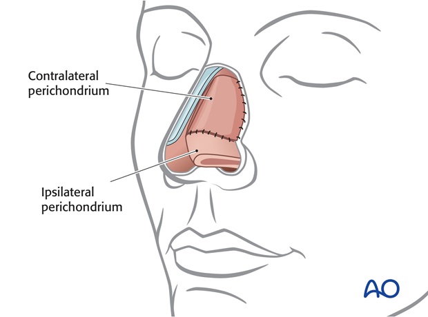 Nose Reconstruction by Dr. Frederick J Menick