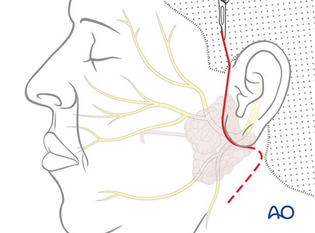 reinnervation with masseteric nerve transposition