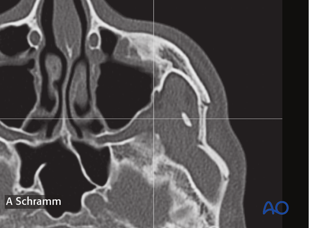 isolated zygomatic arch fracture