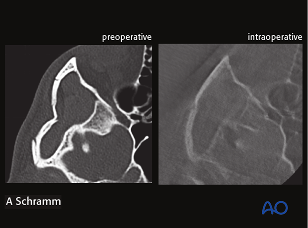 computer assisted surgery zygomatic arch intraoperative imaging closed reduction