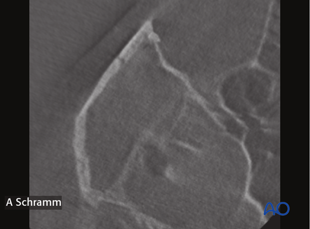 computer assisted surgery zygomatic arch intraoperative imaging closed reduction