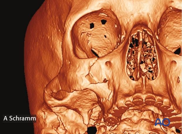 zygomatic complex fracture